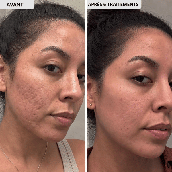 Kit Micro Infusion Anti-Acné